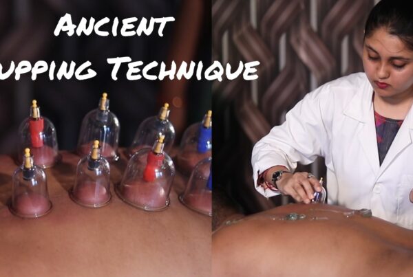 Cupping Therapy