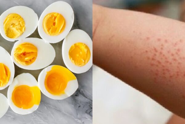 egg allergy