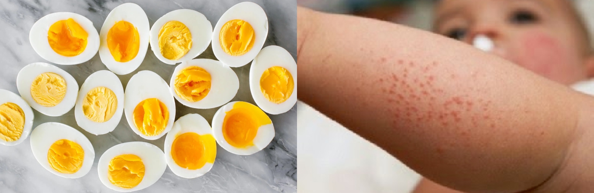 Are you developing these symptoms? You might have egg allergy