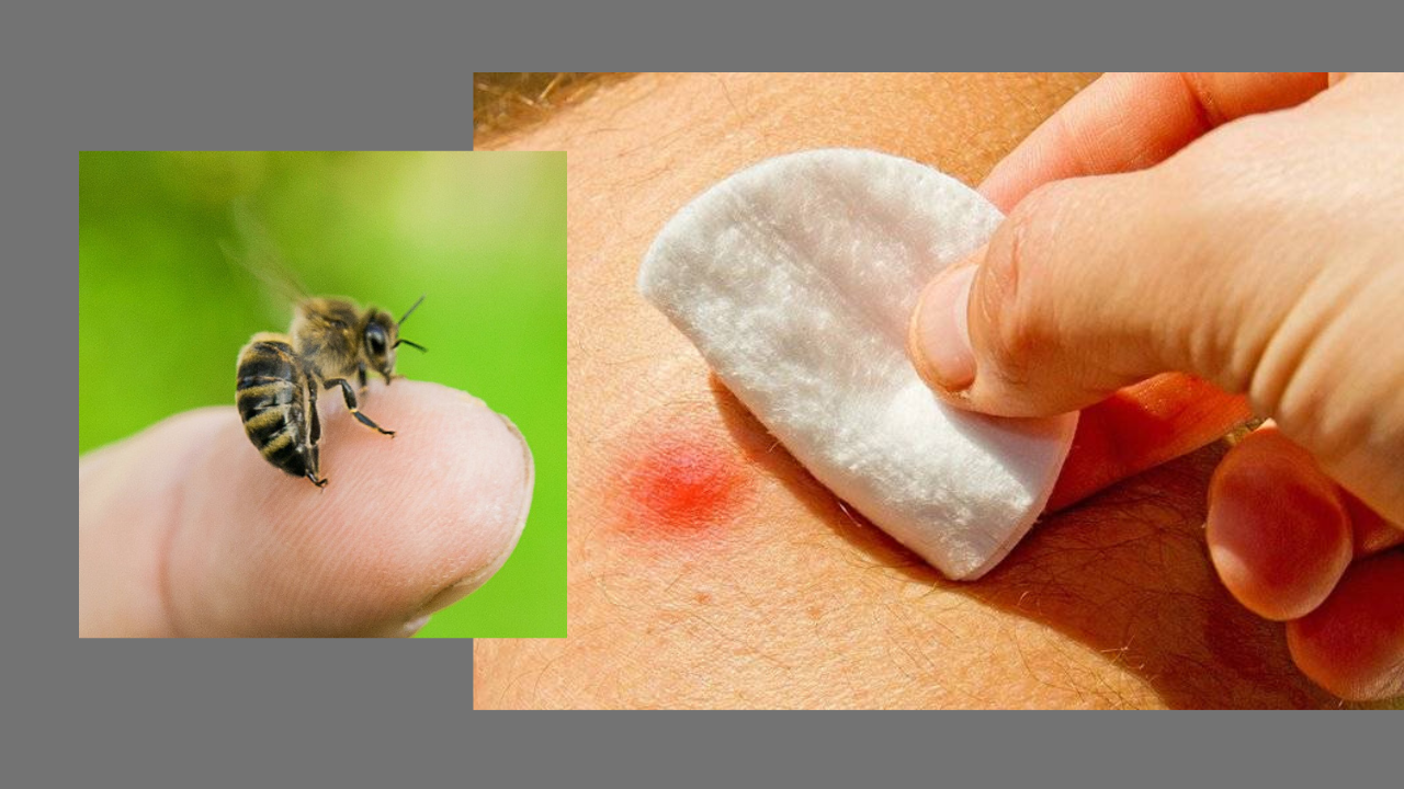 Bee sting allergy: All you need to know