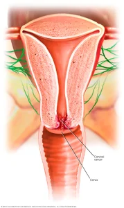 cervical cancer