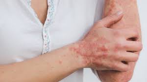 psoriasis