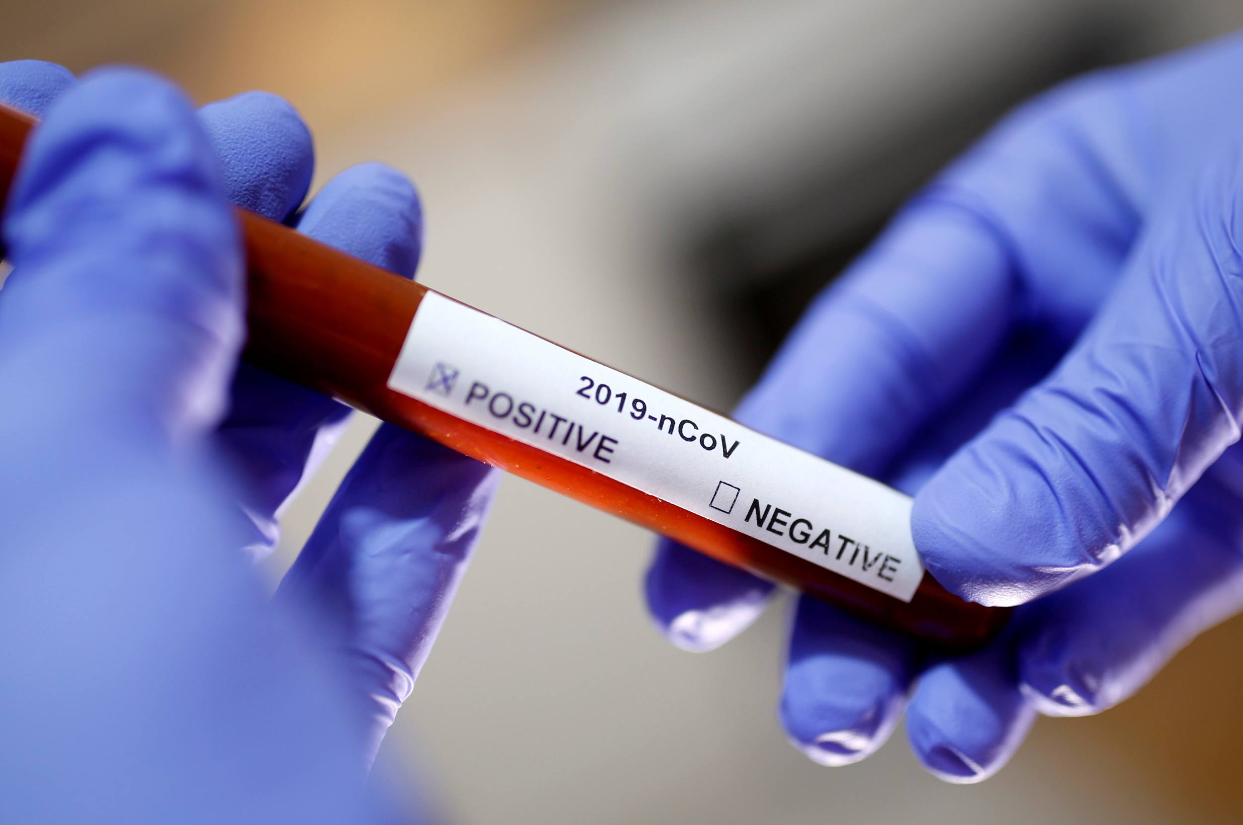 Odisha Reports First COVID-19 Case in Capital; Health Officials Urge Public to Stay Calm