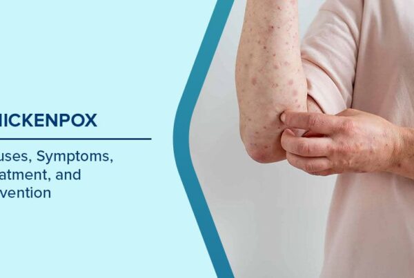 chickenpox