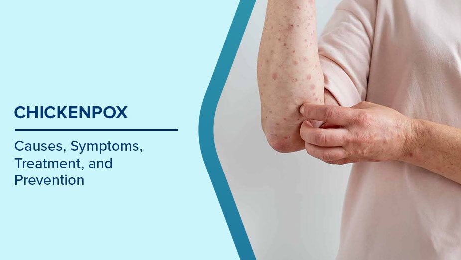 Understanding Chickenpox: Symptoms, Causes, and Prevention